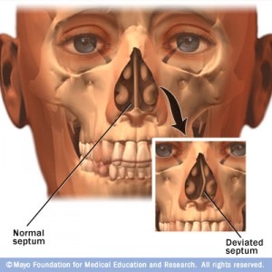 Deviated Septum Repair Surgery in Los Angeles,California | Socal Sinus