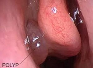 Polyps Treatment in Los Angeles, CA