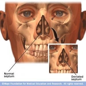 Deviated Septum Repair Los Angeles