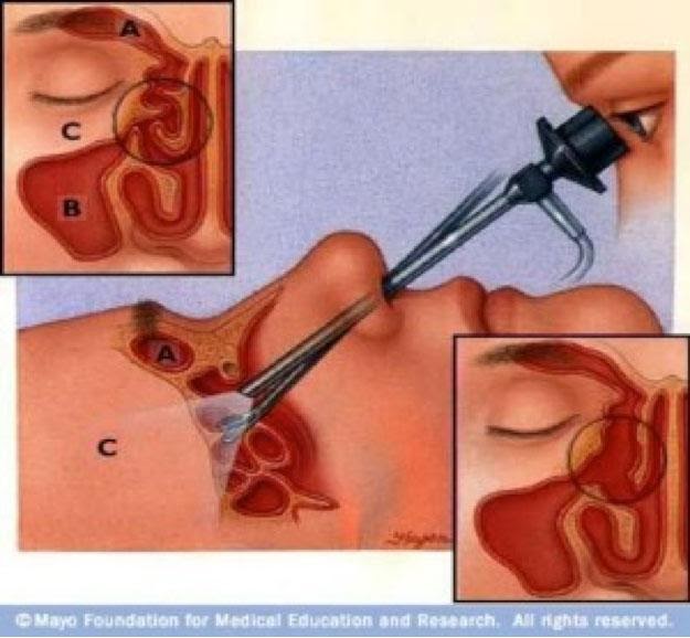 Minimally Invasive Image-Guided Endoscopic Sinus Surgery