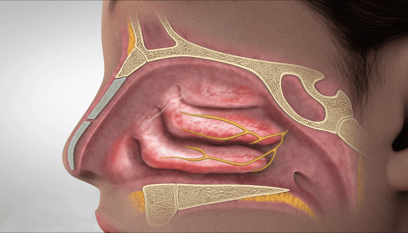 Clarifix Chronic Rhinitis Los Angeles