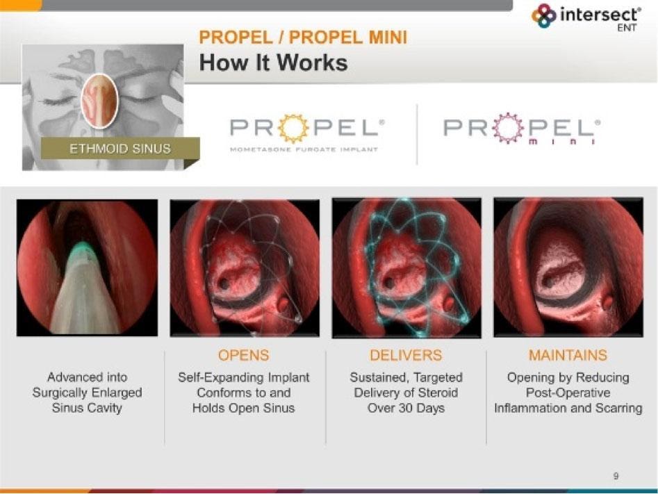 Revision Sinus Surgery in Los Angeles with Dr. Cohen