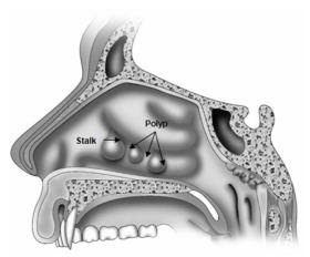 Los Angeles Sinus Polyps Treatment