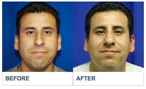 Deviated Septum Repair Los Aneles Before & After