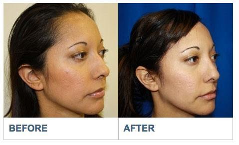 Deviated Septum Repair Los Aneles Before & After