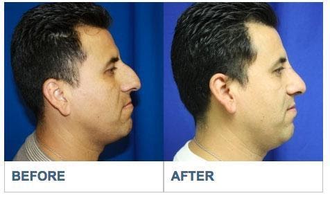 Deviated Septum Repair Los Aneles Before & After