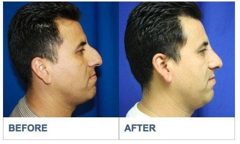 Deviated Septum Repair Los Aneles Before & After