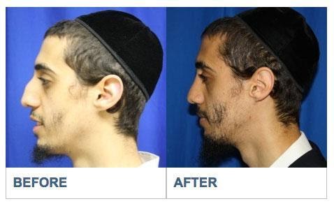 Deviated Septum Repair Los Aneles Before & After