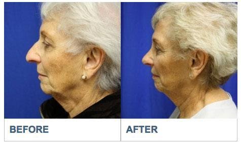 Deviated Septum Repair Los Aneles Before & After