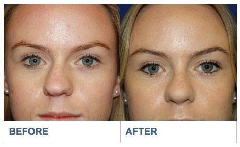 Deviated Septum Repair Los Aneles Before & After