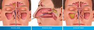 Balloon Sinuplasty Los angeles
