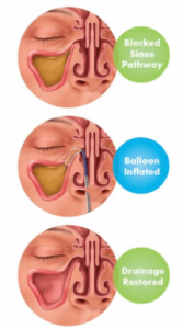 LOS ANGELES BALLOON SINUPLASTY