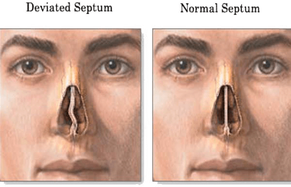 how to tell if you have a deviated septum