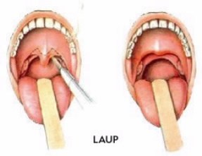 In-office Laser Assisted Uvulopalatoplasty (LAUP) 
