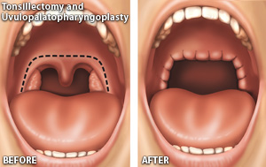 Tonsillectomy and Adenoidectomy Los Angeles