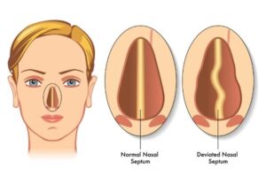 A Guide On Deviated Septum- Deviated Septum FAQs