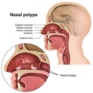 polyps in nasal cavity