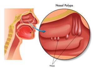 polyps nasal