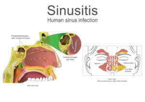 sinusitis