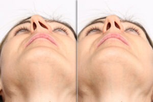 Before - After