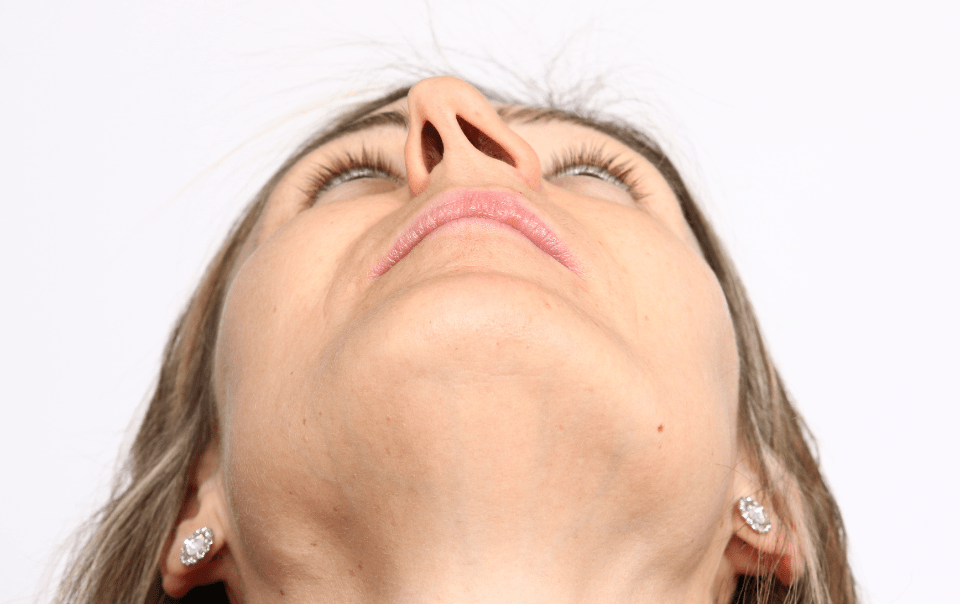 deviated septum surgery Los Angeles