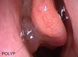 Polyps Treatment in Los Angeles, CA