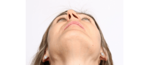 deviated septum