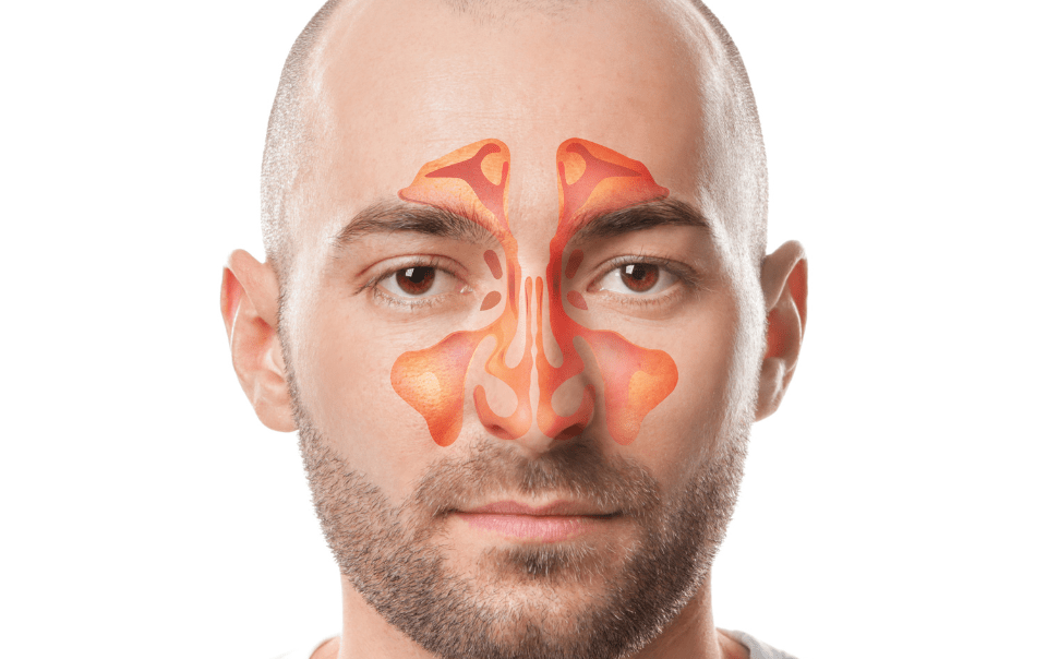 What to Expect After In-Office Balloon Sinuplasty