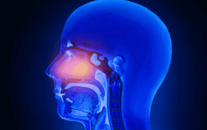 nasal polyps