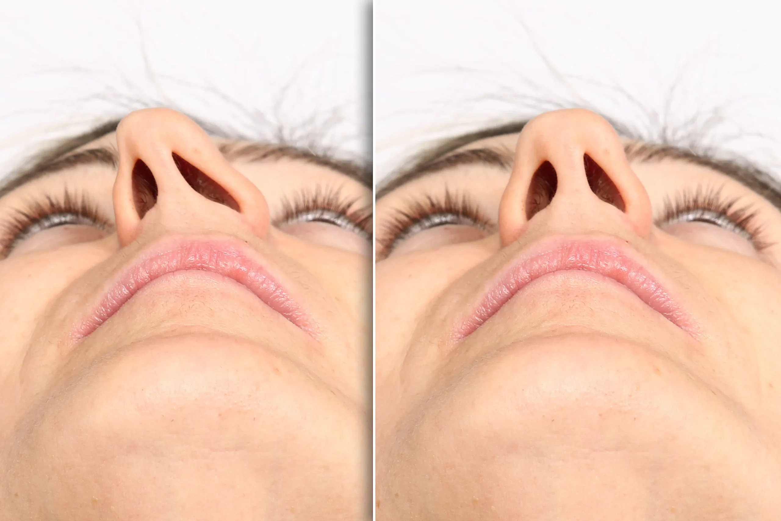 Side-by-side close-up of a nose before and after treatment