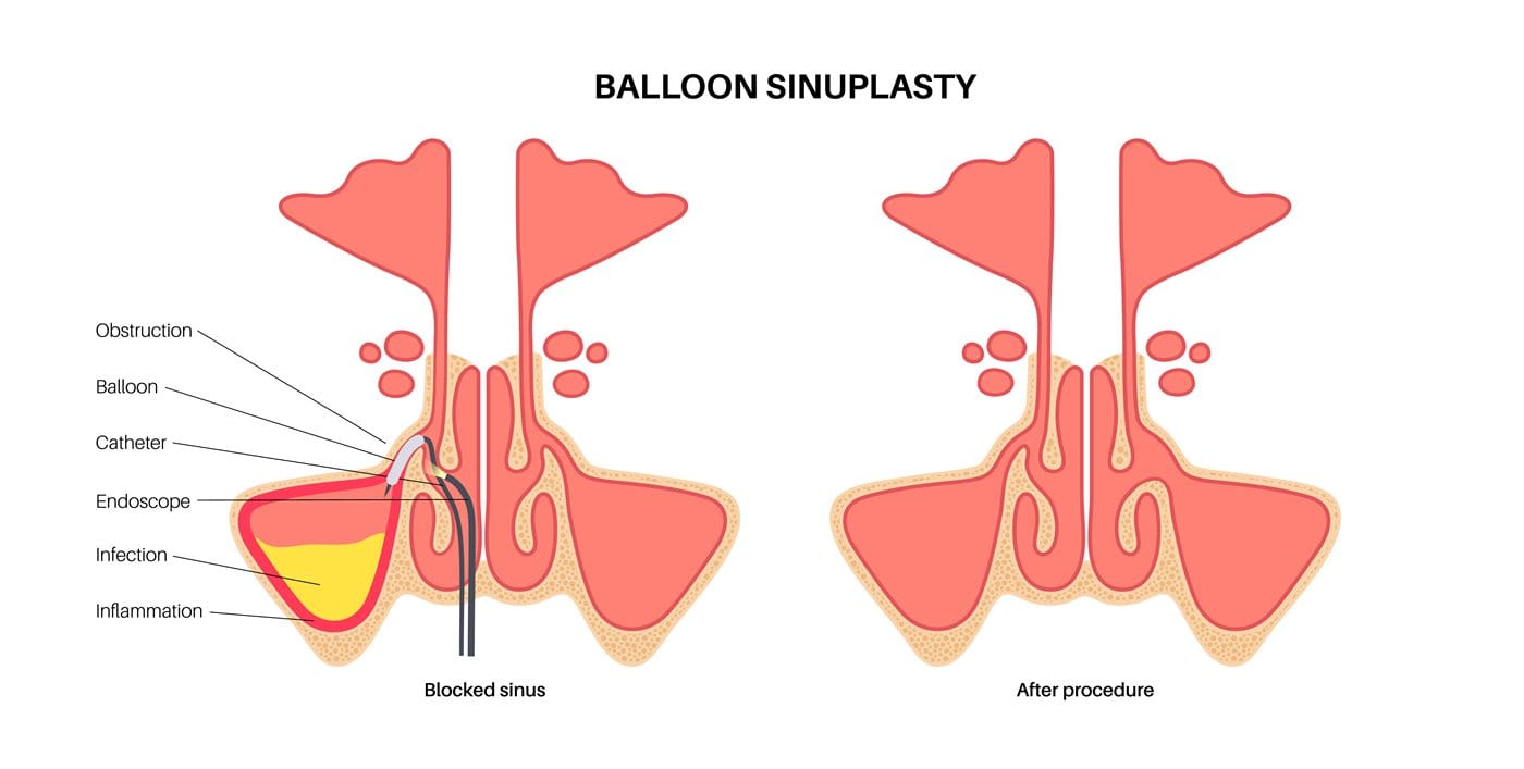 Balloon sinuplasty diagram comparing a blocked sinus before and after the procedure