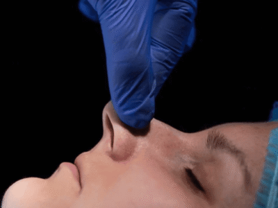 Deviated Septum Repair for Trouble Breathing Through One Nostril